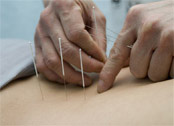 acupuncture