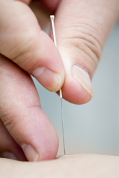 acupuncture2