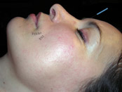  Facial Acupuncture